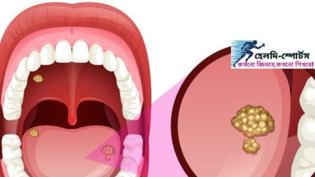 জিহ্বার ঘা দূর করার উপায়