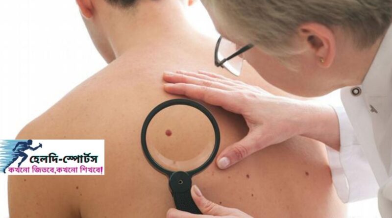 আঁচিল দূর করার উপায়