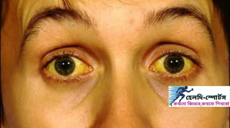 জন্ডিসের লক্ষণ