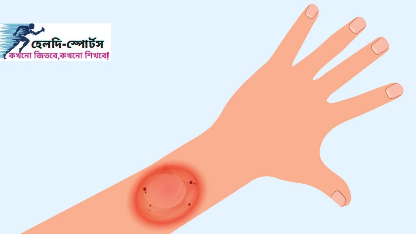 দাদ এর চিকিৎসা