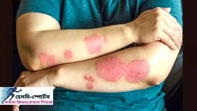 চর্ম রোগের ঘরোয়া চিকিৎসা