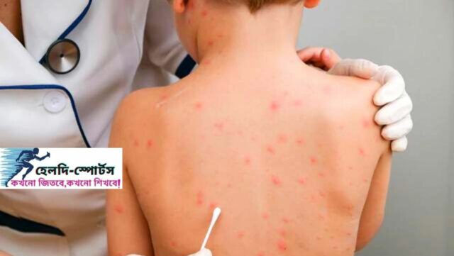 বসন্ত রোগ নিরাময়ের উপায়