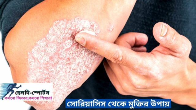 সোরিয়াসিস থেকে মুক্তির উপায়